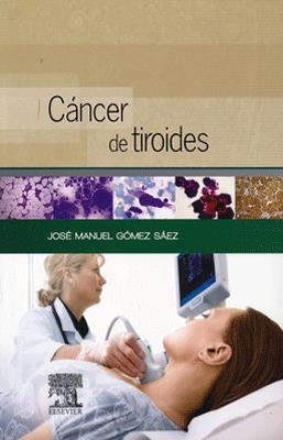 CANCER DE TIROIDES