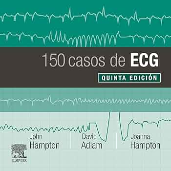 150 CASOS DE ECG