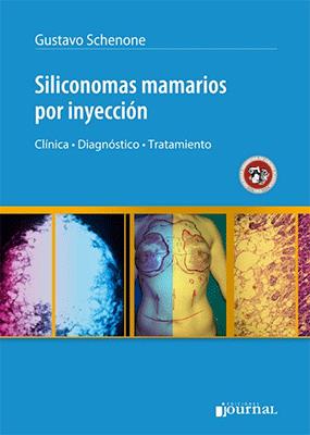 SILICONOMAS MAMARIOS POR INYECCION